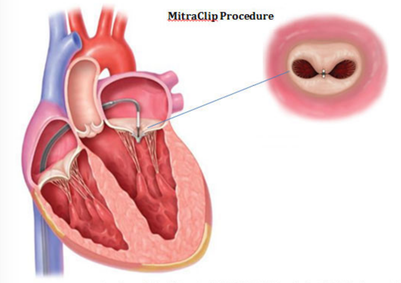 Ayurvedic Treatment For Leaking of Heart Valves Ayurvedic Treatment For Leaking of Heart Valves